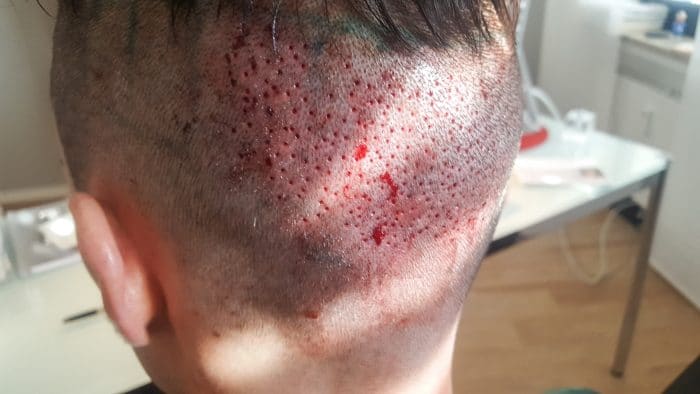 Meine Erfahrungen mit einer Haartransplantation