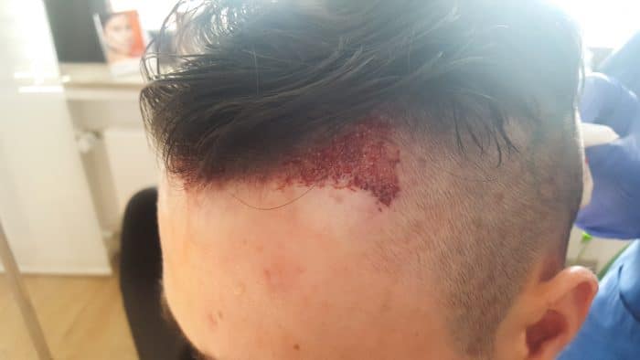 Meine Erfahrungen mit einer Haartransplantation