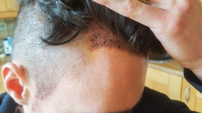 Meine Erfahrungen mit einer Haartransplantation