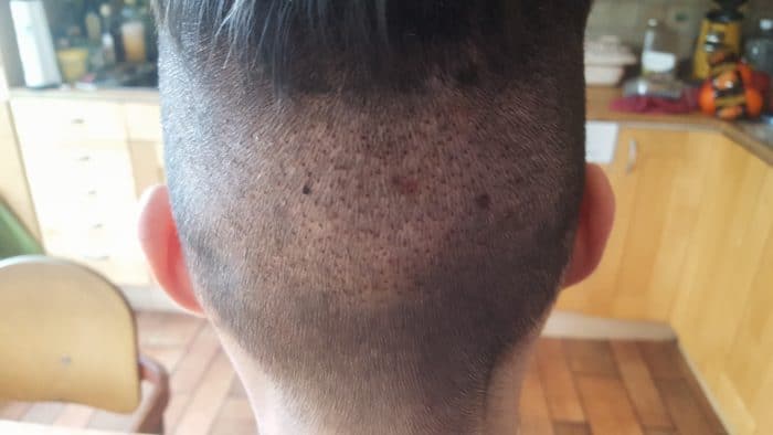 Meine Erfahrungen mit einer Haartransplantation