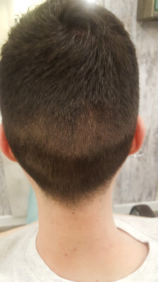 Meine Erfahrungen mit einer Haartransplantation