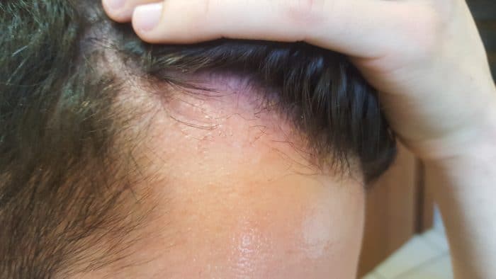 Meine Erfahrungen mit einer Haartransplantation